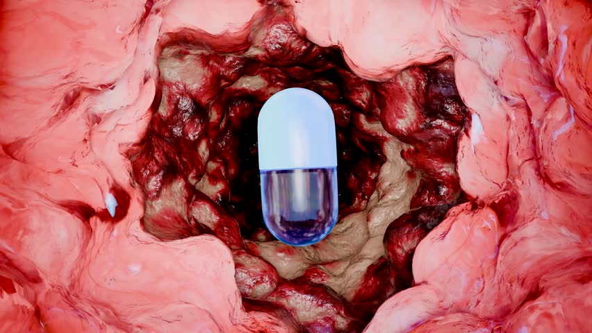 inflammatory bowel Disease traitement, Colorectal cancer, malignant tumor, Endoscope colonoscopy, gut intestine, Colon polyp removal, intestinal carcinoma, bowel neoplasia, Capsule, pill, 3d render
