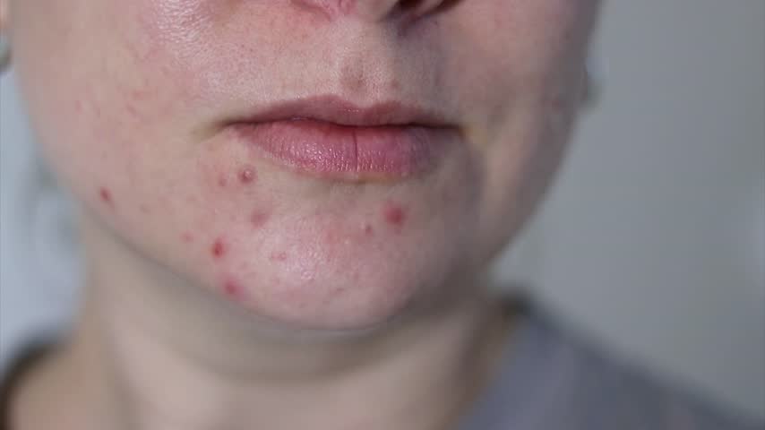 Close up of female face with red problematic acne skin Royalty-Free Stock Footage #3494638463