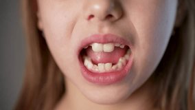 Little girl shaking tongue milk tooth in mouth, close-up. The child shakes the front baby tooth. Children's dentistry stomatology and losing tooth