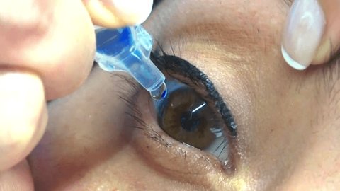 Girl dropping medical eye drops into the eye. 库存视频