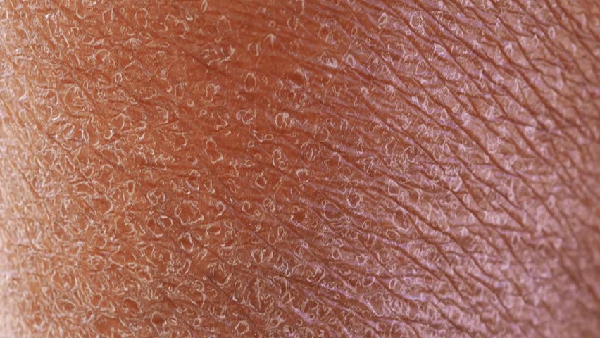 Dry skin or ichthyosis texture detail on leg women using for skincare and moisturizer lotion, cream or cosmetics product concept.