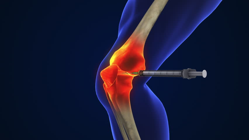 Anatomy Human Knee Joint Treatment, Osteoarthritis Injection