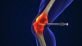 Anatomy Human Knee Joint Treatment, Osteoarthritis Injection - Powered by Shutterstock - Get 15% off with code: PIKWIZARD15