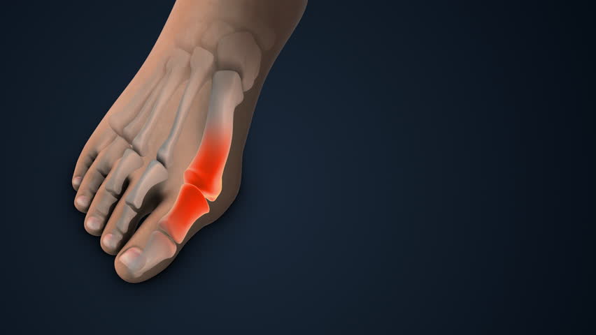 Hallux Valgus Correction Bunion Surgery in foot