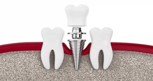 4k Resolution Video: Dental Implant Installation and Crown Placement on a White Background with Alpha Mate