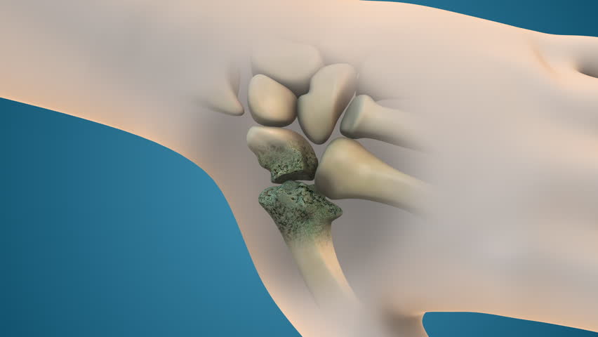 Arthritis of the finger and thumb joint
