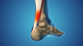 Sprained ankle pain and swollen inflammation - Powered by Shutterstock - Get 15% off with code: PIKWIZARD15