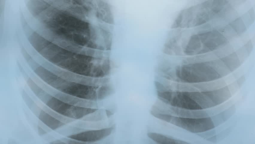 Doctor examining Fluorography, x-ray scan. Medical treatment concept ...
