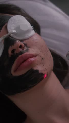 Carbon peeling of the face of a young beautiful girl. Skin care cosmetology. Laser therapy and skin treatment. Vertical video.