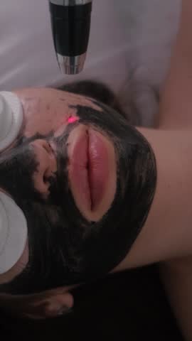 Carbon peeling of the face of a young beautiful girl. Skin care cosmetology. Laser therapy and skin treatment. Vertical video.