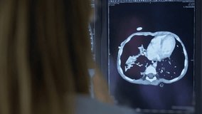 Physician Looking at the Patient's Lung X-Ray Scan on the Monitor and Doing Test Results Analysis. Health Care Clinic Research Laboratory, Radiology, Radiologist Looking at MRI CT Scans, Lung Cancer - Powered by Shutterstock - Get 15% off with code: PIKWIZARD15