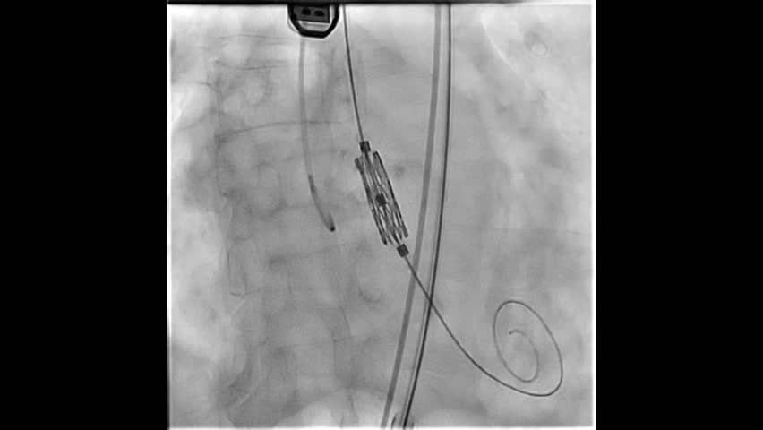 Transcatheter Aortic Valve Replacement with balloon expandable valve