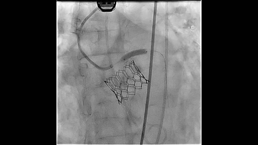 Transcatheter Aortic Valve Replacement balloon inflated to Left Main and left anterior descending artery.