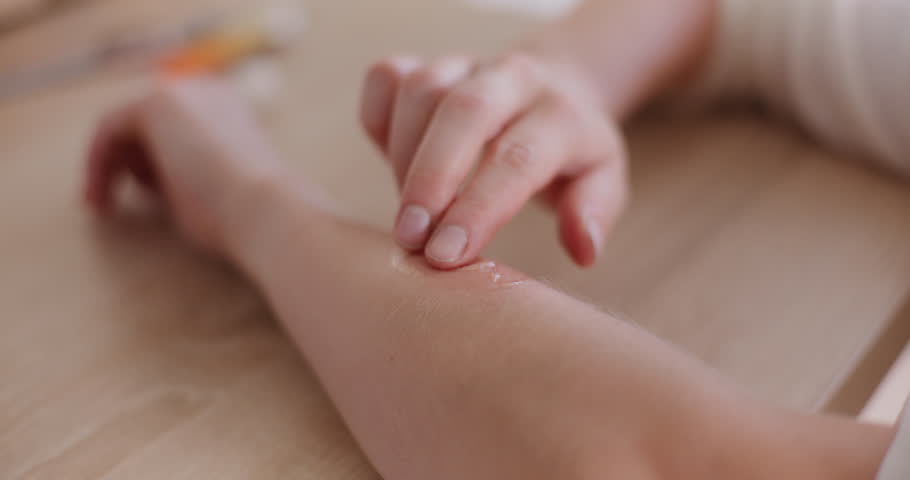 Woman spreading a soothing gel on her hand after a wasp sting