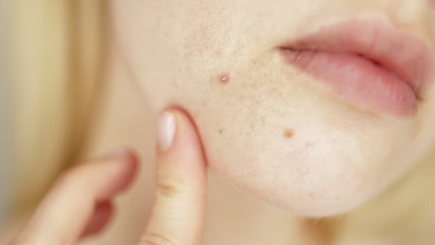 Problems face skin with acne and enlarged pores. Woman touching her face with a pimple, redness and uneven texture. Skincare and dermatology concept.