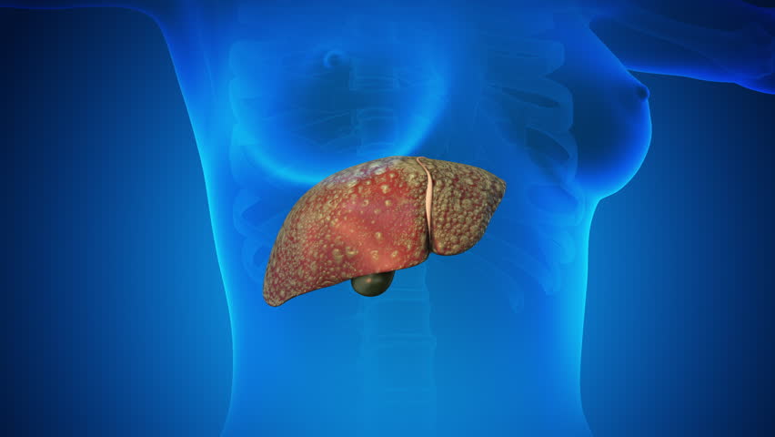 Female healthy liver turning into a fatty liver