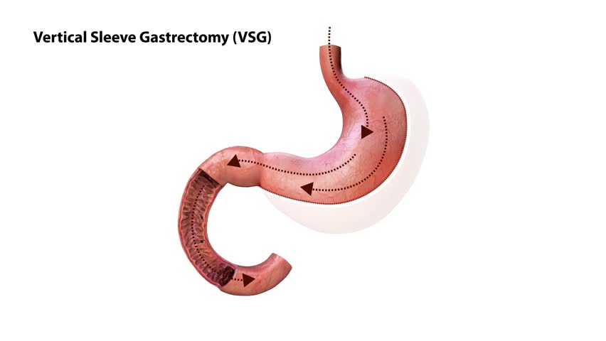 Laparoscopic Sleeve Gastrectomy Logo, Vertical Gastrectomy Logo , Weight loss surgery 3d animation of Stomach reduction logo surgery, vertical