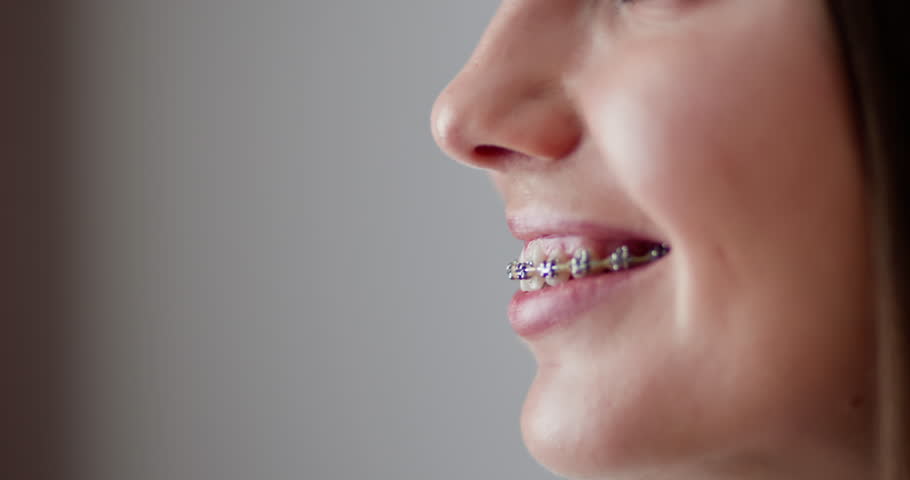 Dental Braces And Healthy Teeth. Close up of a woman with dental braces smiling. Concept of orthodontic treatment and oral hygiene. Beautiful smile showcasing metal braces for teeth alignment