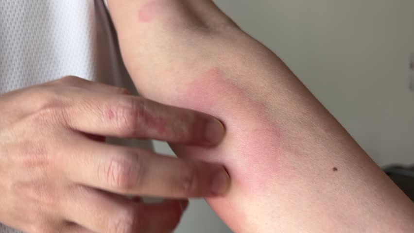 Young asian man itching and scratching on arm from itchy dry skin eczema dermatitis