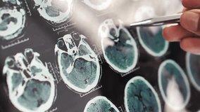 Doctor's hand using pen to pointing at brain x-rays on digital tablet. Doctor analyzing CT or MRI Brain Scan Images. Brain X-ray image on Digital Tablet. - Powered by Shutterstock - Get 15% off with code: PIKWIZARD15