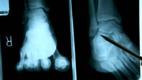 Doctor examined a patient with pain in joint and x-ray of foot. surgeon shows x-ray picture of patient's injured foot. Doctor analyzing foot x-ray scan. - Powered by Shutterstock - Get 15% off with code: PIKWIZARD15