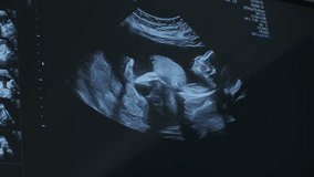 Ultrasound sonogram of fetus actively moving in womb closeup. Regular prenatal checkup services to control healthy development of baby - Powered by Shutterstock - Get 15% off with code: PIKWIZARD15