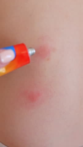 kid with lot of insects, mosquito, fleas or other parasites bites on body, back and legs.child scratches bug bites.lying baby boy toddler on pillow. .woman applying cream. sstkVertical