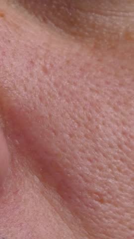 Man with acne long-term skin disease near nose. Beauty, skin care lifestyle concept. Pimples on face