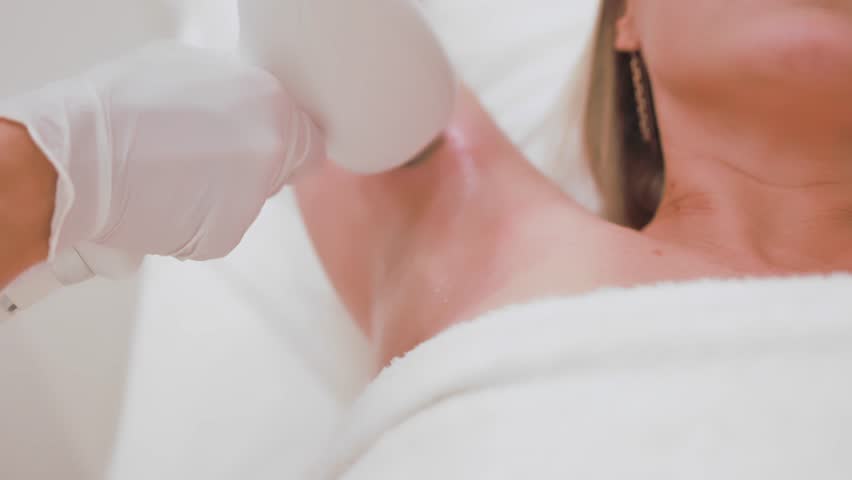 Hair removal with diode laser.