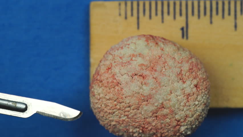 Veterinarian removing extremely large Bladder stone in a dog, calcium oxalate