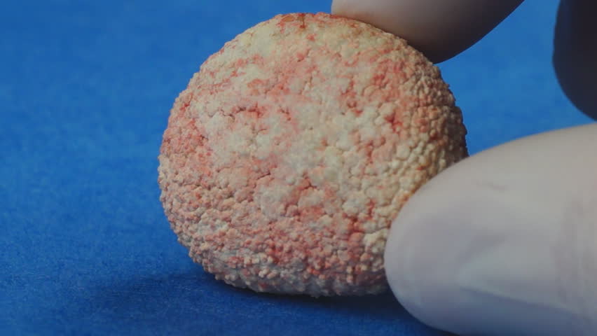 Veterinarian showing extremely large Bladder stone removed from a dog, calcium