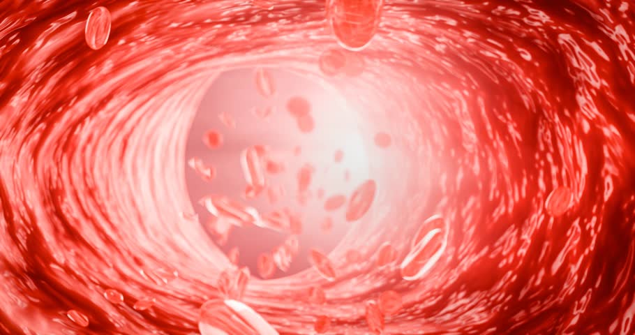 Hyperlipidemia or arteriosclerosis. Blocked artery concept and human blood vessel as a disease with cholesterol fat buildup clogging. Clogged arteries, Cholesterol plaque in the artery. 3D Rendering