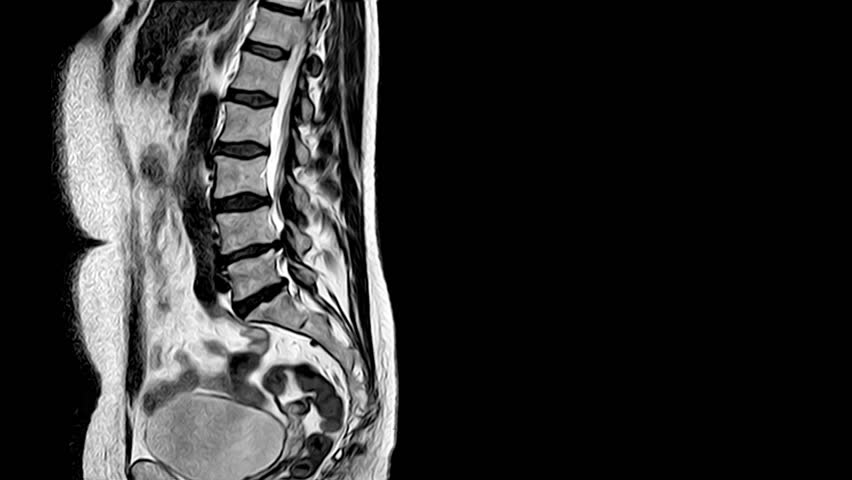 X-ray of the back on a black background. Flashing red signal of pain in the lower back. MRI of the human back. Free space for text.