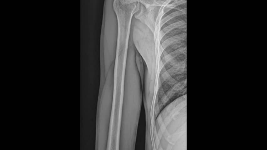 Humerus X-Ray: Diagnostic Imaging For Humeral Fracture 