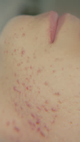 Close-up shot of a face with problem skin acne on the skin 