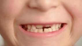 Dentist of the loss of milk teeth in a 6-year-old child. Growth of teeth in the mouth of a child, a boy. High quality 4k footage - Powered by Shutterstock - Get 15% off with code: PIKWIZARD15