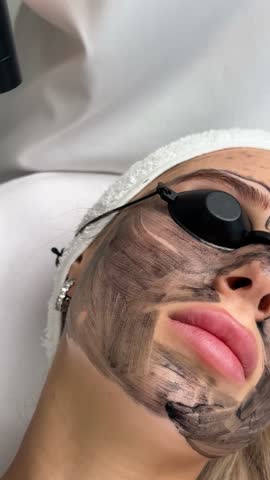 Close-up of cosmetologist's hand making hardware carbon peeling by young pretty customer woman in safety glasses headdress lying on couch in beauty salon. Facial cleaning concept. Cosmetology Services