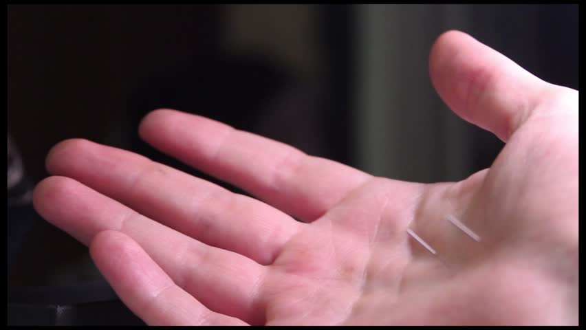 SuJok Acupuncture medicine: needles inserted in a hand.