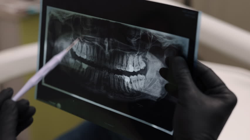Gloved hand, Dental care, Dental procedure. Close-up view shows gloved hand using dental tool to examine dental X-ray.