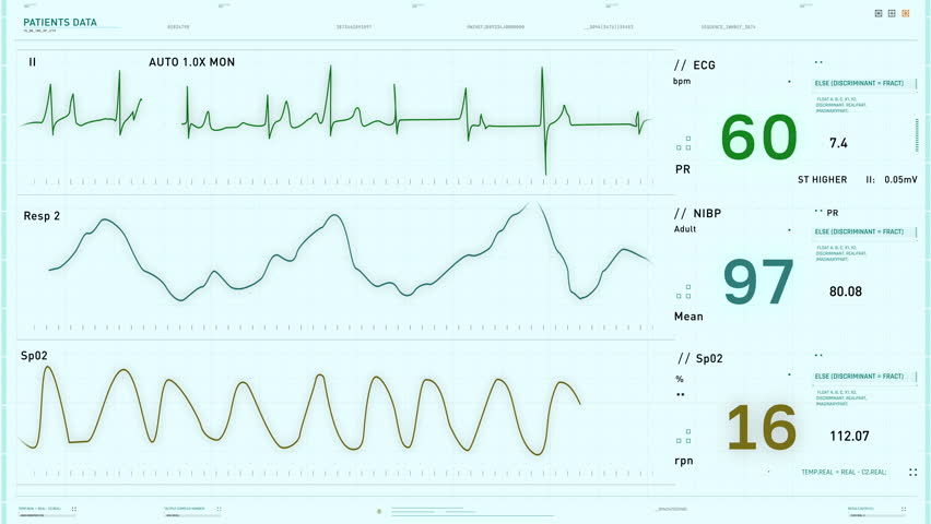 Graph Of Heart Rate Monitoring Device Interface Shows Death Of Patient. Graph On Hospital Monitoring Device. Vital Signs Decrease. Graph Of Monitoring Device Warns Of Patients Critical Condition