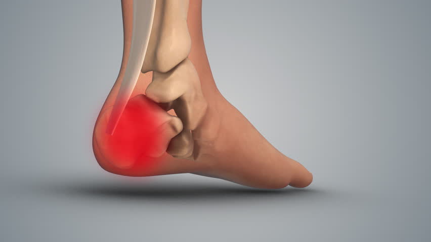 A painful inflammation in the heel