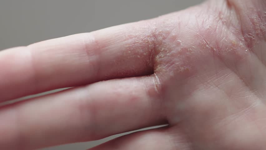 close-up dry cracked skin palm hand inflammation psoriasis dermatitis or eczema. macro view of dry peeling skin yellow crusts and cracks, wounds of allergy on hand and fingers. eczematous dermatitis