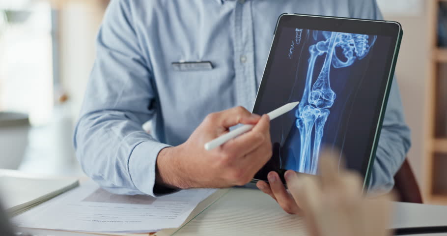 Osteoporosis, consultant and xray with tablet screen and hands for medical, report or treatment. Doctor, medicine or synthetic stem cell therapy with people and bone marrow transplant breakthrough