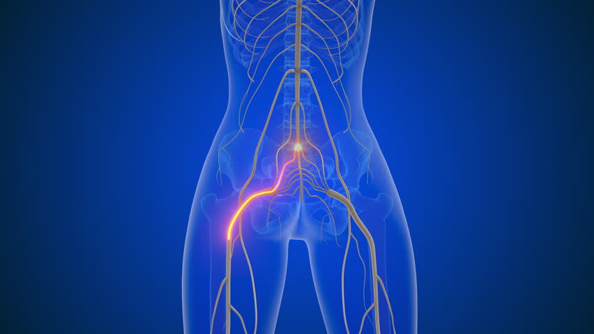 Sciatica causing lower back to leg discomfort