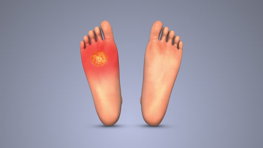 Diabetic Foot Ulcer – Chronic Wound and Skin Complication