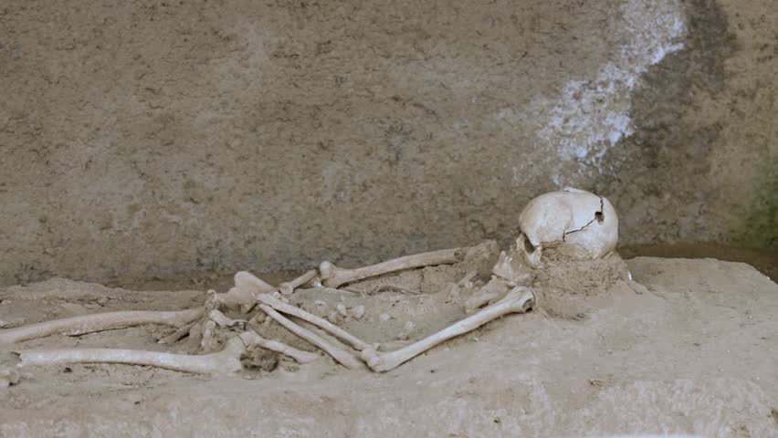 Trepanned skeleton with surgery intervention skull burr hole. Human skull with trepanation.