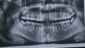 dentist hand pointing at X-ray of teeth on the monitor. Dentist looking at x-ray. Dentist using panoramic x-ray images to describe dental procedure. - Powered by Shutterstock - Get 15% off with code: PIKWIZARD15