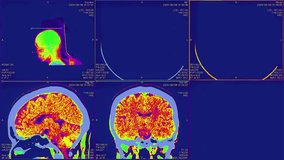 Magnetic resonance images of the head, MRI of the brain,top viev of a patient with multiple vascular infarctions, 3x3 image grid, color animation Seamless Loop - Powered by Shutterstock - Get 15% off with code: PIKWIZARD15
