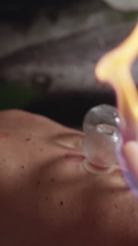 Vertical Screen: Therapist Heating Suction Cups Using Fire Cupping Stick and Putting Them on Client's Back. Concept of Cupping Therapy, Traditional, Chinese, Alternative Medicine, Treatment