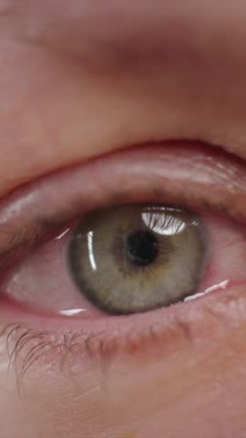 Red blood eye of woman affected by conjunctivitis or after flu, cold or allergy